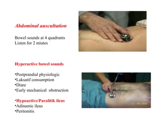 Abdominal auscultation
Bowel sounds at 4 quadrants
Listen for 2 miutes
Hyperactive bowel sounds
•Postprandial physiologic
•Laksatif consumption
•Diare
•Early mechanical obstruction
•Hypoactive/Paralitik ileus
•Adinamic ileus
•Peritonitis
 