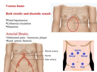 Venous hums
Both sistolic and diastolic sounds
Portal hipertansion
Collatersal circulation
Hepatoma
Arterial Bruits:
•Abdominal aorta : Aneurysm, plaque
•Renal arteria: Stenosis
 