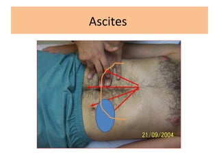 Ascites
 
