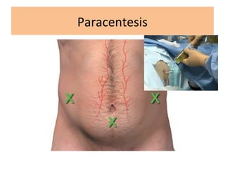 Paracentesis
 