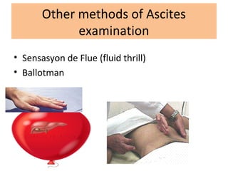 Other methods of Ascites
examination
• Sensasyon de Flue (fluid thrill)
• Ballotman
 