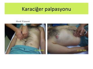 Karaciğer palpasyonu
Hook Yöntemi
 