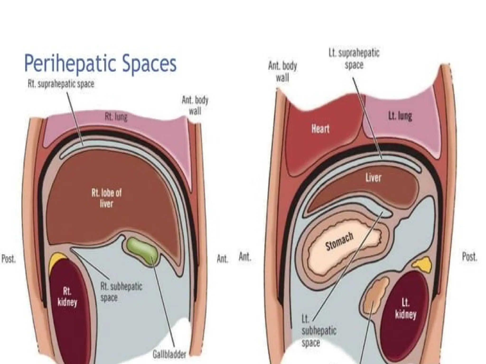 intra abdominal abscess and its management | PPTX
