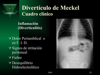 Divertículo de Meckel Cuadro clínico Inflamación (Diverticulitis) Dolor Periumblical  o en F. I. D. Signos de irritación peritoneal Fiebre Desequilibrio Hidroelectrolítico 