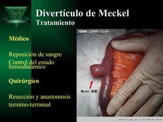Divertículo de Meckel Tratamiento Médico Reposición de sangre Control del estado hemodinámico  Quirúrgico Resección y anastomosis termino-terminal 