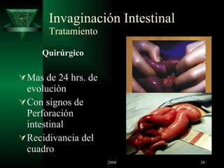 Invaginación Intestinal Tratamiento Quirúrgico Mas de 24 hrs. de evolución Con signos de Perforación intestinal Recidivancia del cuadro 