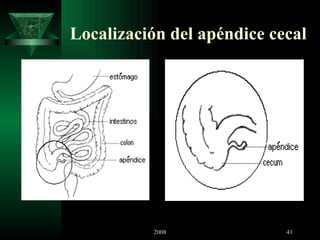 Localización del apéndice cecal 