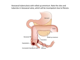 Ileocaecal tuberculosis with rolled up omentum. Note the sites and
tubercles in ileocaecal valve, which will be incompetent due to fibrosis.
 