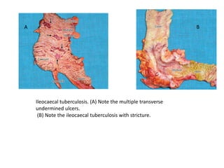 Ileocaecal tuberculosis. (A) Note the multiple transverse
undermined ulcers.
(B) Note the ileocaecal tuberculosis with stricture.
A B
 