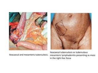 Ileocaecal and mesenteric tuberculosis.
Ileocaecal tuberculosis or tuberculous
mesenteric lymphadenitis presenting as mass
in the right iliac fossa
 