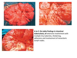 A
B
C
A to C: On-table findings in intestinal
tuberculosis, of extensive involvement with
multiple tiny tubercles, thickening,
adhesions and involvement of mesenteric
lymph nodes.
 