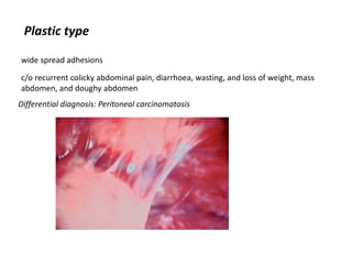 Plastic type
wide spread adhesions
c/o recurrent colicky abdominal pain, diarrhoea, wasting, and loss of weight, mass
abdomen, and doughy abdomen
Differential diagnosis: Peritoneal carcinomatosis
 