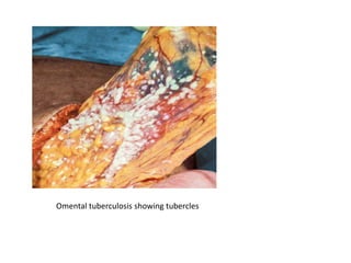 Omental tuberculosis showing tubercles
 