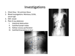 Investigations
1. Chest Xray – for primary focus
2. Blood investgations: Mantoux, ELISA,
serum IgG
3. ESR- raised
4. Plain X-ray abdomen
I. Intestinal obstruction
II. Calcified lymph nodes
III. Hollow viscous perforation
IV. Calcified Granuloma in liver
 