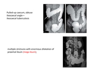 Pulled-up caecum, obtuse
ileocaecal angle—
ileocaecal tuberculosis
multiple strictures with enormous dilatation of
proximal ileum (mega ileum);
 