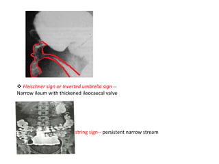  Fleischner sign or Inverted umbrella sign --
Narrow ileum with thickened ileocaecal valve
string sign-- persistent narrow stream
 