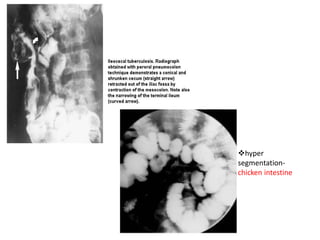 hyper
segmentation-
chicken intestine
 