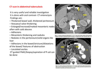 CT scan in abdominal tuberculosis
It is very useful and reliable investigation
It is done with oral contrast- CT enteroclysis
Findings are:
– Thickened bowel wall, thickened peritoneum
– Ileocaecal valve thickening
– Enlarged/necrosed/matted mesenteric nodes
often with cold abscess
– Adhesions
– Mesenteric thickening and nodules
– Nodules in the peritoneum/solid organs like
liver
– Adhesions in the bowel/stricture/dilatations
of the bowel/ features of obstruction
– Loculated ascites
CT guided FNAC/biopsy/aspiration of fl uid can
be done
 