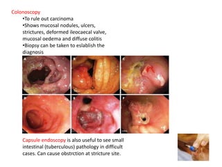 Colonoscopy
•To rule out carcinoma
•Shows mucosal nodules, ulcers,
strictures, deformed ileocaecal valve,
mucosal oedema and diffuse colitis
•Biopsy can be taken to eslablish the
diagnosis
Capsule endoscopy is also useful to see small
intestinal (tuberculous) pathology in difficult
cases. Can cause obstrction at stricture site.
 