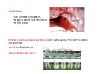 Laparoscopy
•aids in direct visualisation,
•to collect ascitic fluid for analysis
•to take biopsy
Blind percutaneous needle peritoneal biopsy using Cope’s/ Abraham’s needle is
also practiced.
Ascitic tap fluid analysis
Bactec MGIT broth culture
 