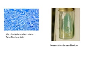 Mycobacterium tuberculosis:
Ziehl-Neelsen stain
Lowenstein-Jensen Medium.
 