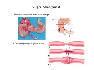 Surgical Management
1. Ileocaecal resection with 5 cm margin
2. Stricturoplasty- single stricture
 