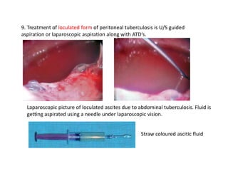 9. Treatment of loculated form of peritoneal tuberculosis is U/S guided
aspiration or laparoscopic aspiration along with ATD‘s.
Laparoscopic picture of loculated ascites due to abdominal tuberculosis. Fluid is
getting aspirated using a needle under laparoscopic vision.
Straw coloured ascitic fluid
 