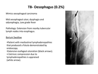 TB- Oesophagus (0.2%)
Mimics oesophageal carcinoma
Mid oesophageal ulcer, dysphagia and
odynophagia, Low grade fever
Pathology: Extension from nearby tubercular
lymph nodes into esophagus.
Barium Swallow
•Patient with mediastinal lymphadenopathies
that produced a fistula demonstrated by
endoscopy.
•Extensive esofageal ulceration (black arrows).
• Extrinsic compression due to
lymphadenopathies is appraised
(white arrow).
 