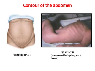 scaphoid-shaped-abdomen