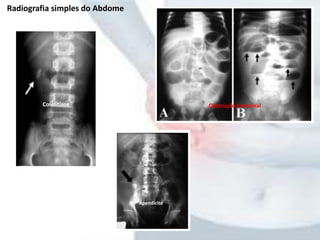 Radiografia simples do Abdome
Apendicite
Colelitíase Obstrução intestinal
 