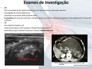 • US:
- Útil na avaliação de dor abdominal alta que não seja ulcerosa ou obstrução intestinal
- Investigação de massas abdominais
- Solicitada em pacientes SEM peritonite óbvia
- É proveitosa em casos de colecistite, colangite aguda, pancreatite, abscessos hepáticos e intra-abdominais e massas RP
e pélvicas
• TC:
- Gás intestinal impedir a US
- Lesões pancreáticas e RP e qualquer infecção localizada intensa
- Pode detectar gás intestinal intramural e venoso: infatRo intestinal
Exames de Investigação
Apêndice edemaciada
 