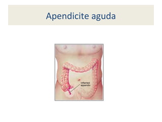 Apendicite aguda
 