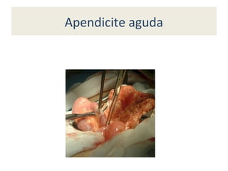 Apendicite aguda
 