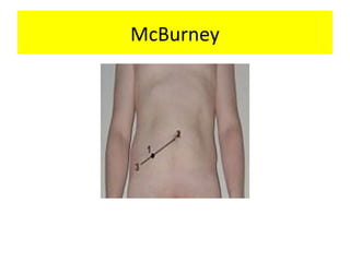 McBurney
 