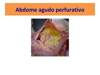 Abdome agudo perfurativo
 