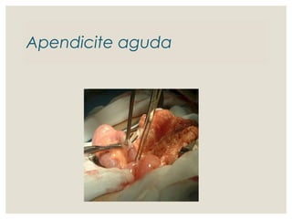 Apendicite aguda
 