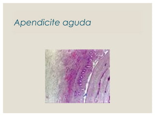Apendicite aguda
 