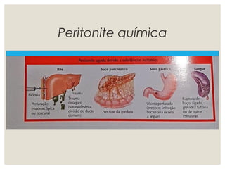 Peritonite química
 