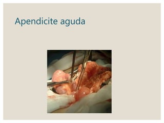 Apendicite aguda
 
