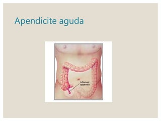 Apendicite aguda
 
