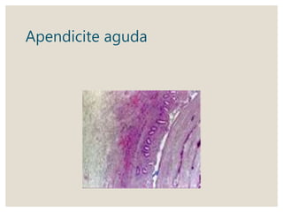Apendicite aguda
 