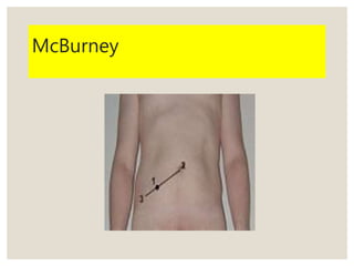McBurney
 