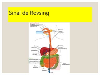 Sinal de Rovsing
 