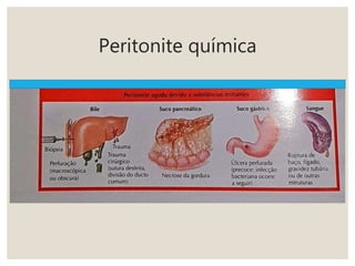 Peritonite química
 