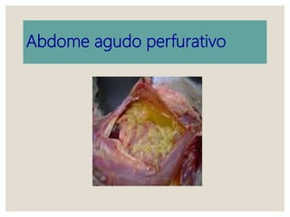 Abdome agudo perfurativo
 