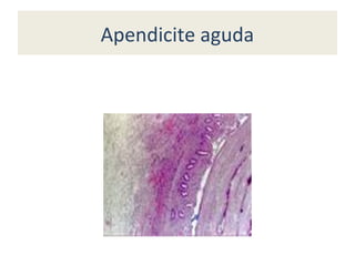 Apendicite aguda
 