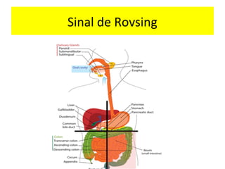 Sinal de Rovsing
 