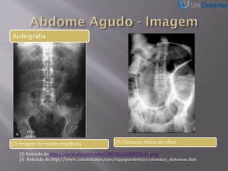 Radiografia
(2) Imagem da moeda empilhada
(2) Retirado de http://www.misodor.com/OBSTRUINTESTINAL.php
(3) Retirado de http://www.colonoscopia.com/fiquepordentro/coloretais_distensao.htm
(3) Dilatação difusa do cólon
 