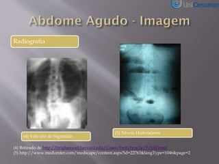 Radiografia
(4) Retirado de http://brighamrad.harvard.edu/Cases/bwh/hcache/5/full.html
(5) http://www.medcenter.com/medscape/content.aspx?id=22763&langType=1046&page=2
(4) Vólvulo de Sigmóide
(5) Níveis Hidroaéreos
 