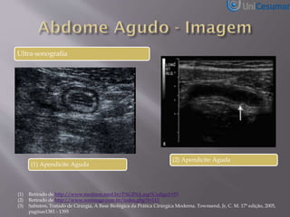 Ultra-sonografia
(1) Apendicite Aguda
(1) Retirado de http://www.medison.med.br/PAGINA.asp?Codigo1=55
(2) Retirado de http://www.sonimage.com.br/index.php?t=113
(3) Sabiston, Tratado de Cirurgia, A Base Biológica da Prática Cirúrgica Moderna. Townsend, Jr, C. M. 17ª edição, 2005,
paginas1381 - 1395
(2) Apendicite Aguda
 